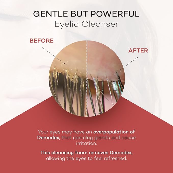 ZocuFoam Eyelid Cleanser - Foaming Eyelid Scrub - Natural pH Balanced Solution - 1.7 FL OZ (50mL)