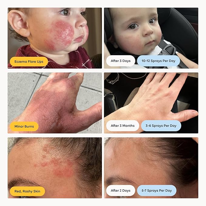 Magic Molecule Skin Cleanser for All Types, Hypochlorous Acid Spray Helps Heal Acne Prone, Eczema and Itchy Rashes and 50 Other Skin Ailments, Safe for Multiple Daily Uses, 8 oz Spray